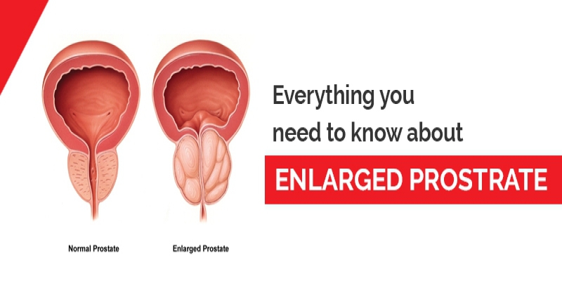Shrink Your Enlarged Prostate Naturally
